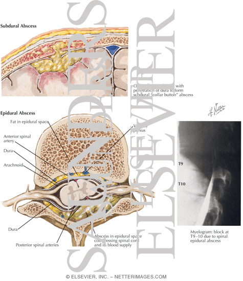 Parameningeal Infections