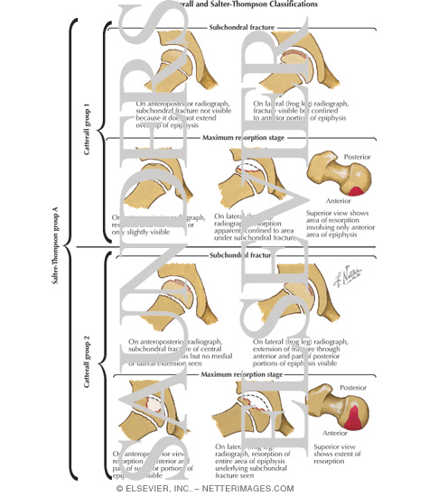 Catterall and Salter-Thompson Classifications
