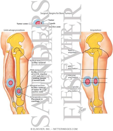 Watermarked preview of labeled image: Surgical Margins for Musculoskeletal Tumors