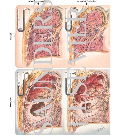 Watermarked preview of labeled image: Gross Pathologic Changes In Emphysema