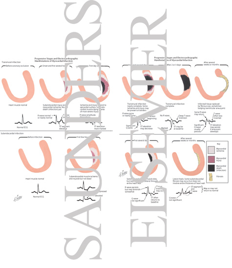 Watermarked preview of labeled image: Progressive Stages and Electrocardiographic Manifestations of Myocardial Infarction
