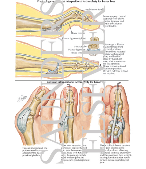 Plantar Ligament (Plate) Interpositional Arthroplasty for Lesser Toes, Capsular Interpositional Arthroplasty for Great Toe