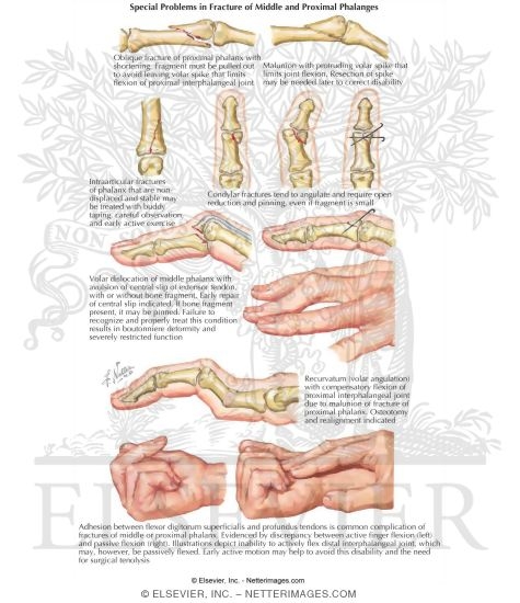 Special Problems in Fracture of Middle and Proximal Phalanges