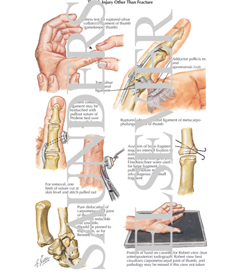 Watermarked preview of labeled image: Thumb Injury Other Than Fracture