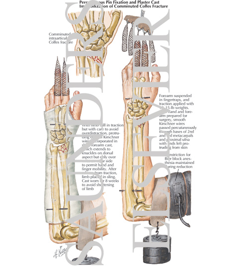 Percutaneous Pin Fixation and Plaster Cast Immobilization of Comminuted Colles Fracture