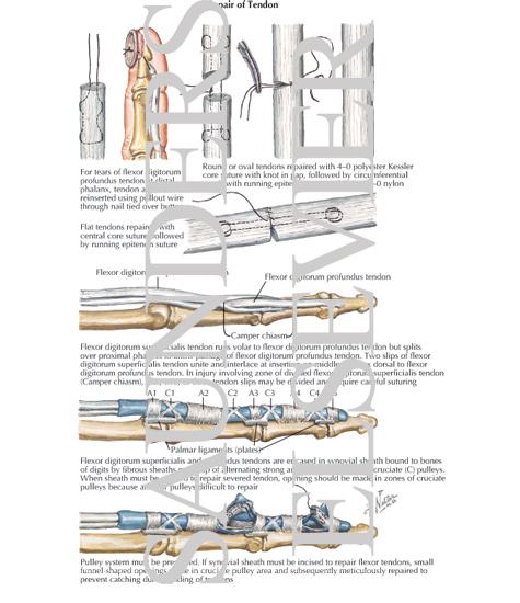 Watermarked preview of labeled image: Repair of Tendon
Lumbrical Muscles, Bursae, Spaces and Sheaths: Schema