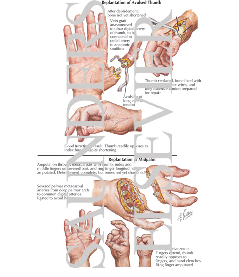 Watermarked preview of labeled image: Replantation of Avulsed Thumb and Midpalm