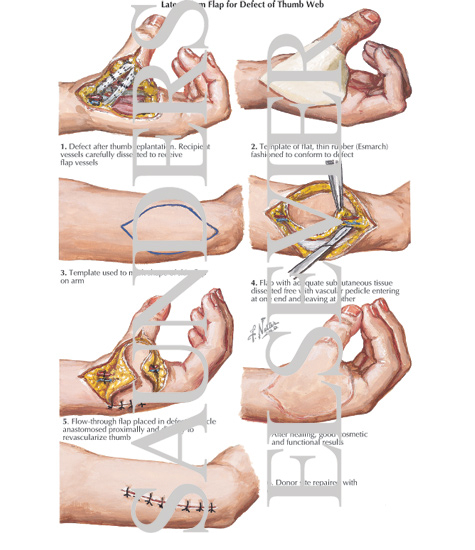 Watermarked preview of labeled image: Lateral Arm Flap for Defect of Thumb Web