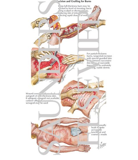 Watermarked preview of labeled image: Excision and Grafting for Burns
