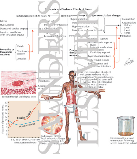 Metabolic and Systemic Effects of Burns