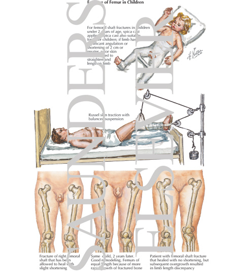 Fracture Of Femur In Children