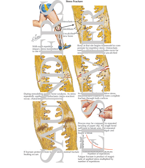 Watermarked preview of labeled image: Stress Fracture