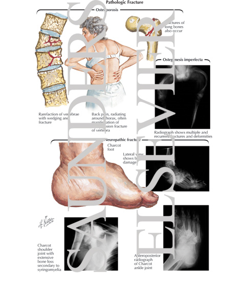 Watermarked preview of labeled image: Pathologic Fracture