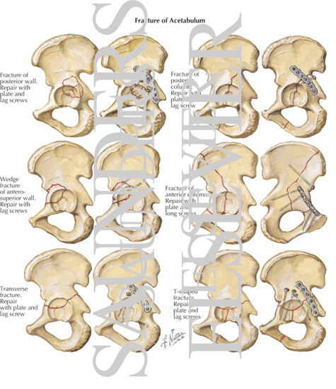 Fracture of Acetabulum