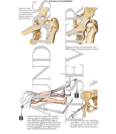 Watermarked preview of labeled image: Fracture of Acetabulum