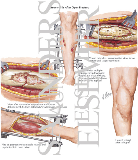 Watermarked preview of labeled image: Osteomyelitis After Open Fracture