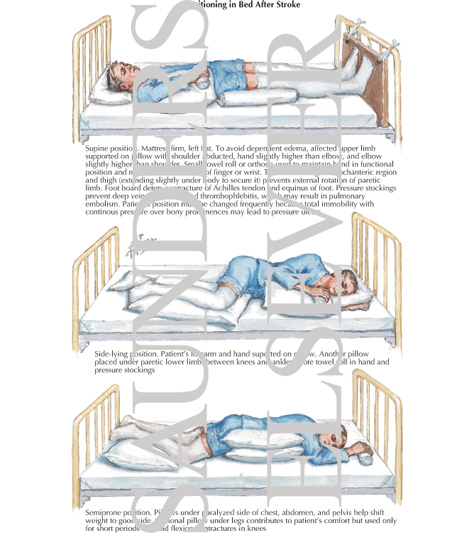 Positioning in Bed After Stroke