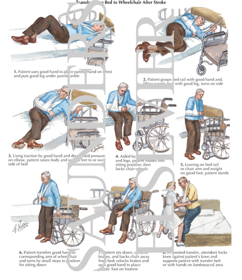 Transfer From Bed To Wheelchair After Stroke