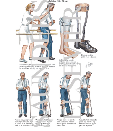 Ambulation After Stroke
