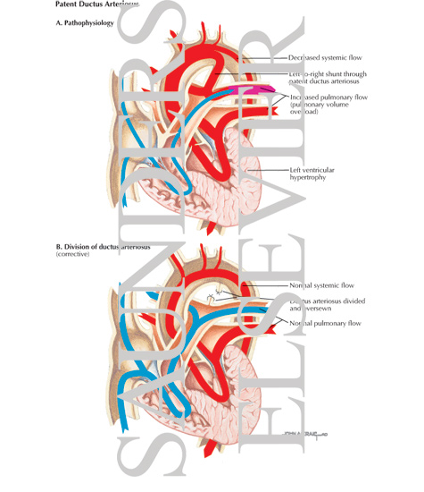 Patent Ductus Arteriosus