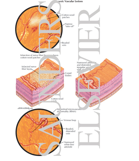 Watermarked preview of labeled image: Hypoxic Vascular Lesions