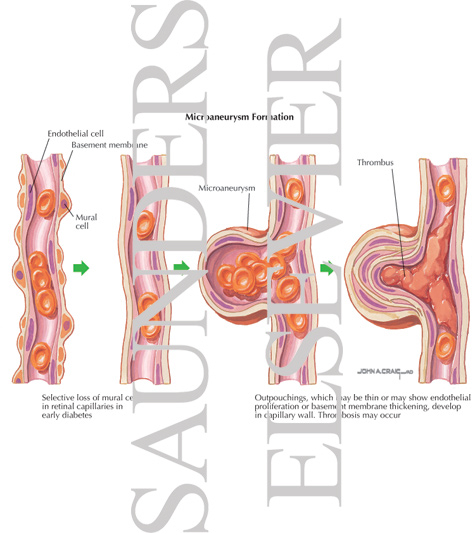 Microaneurysms