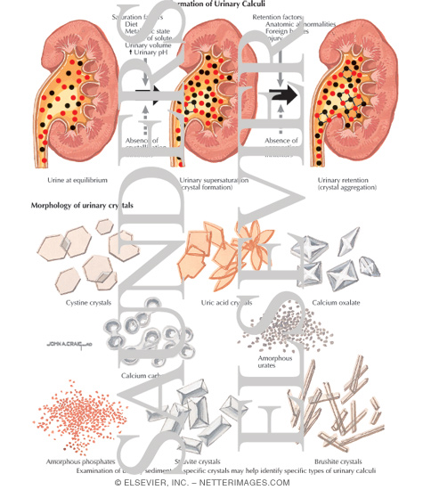 Watermarked preview of labeled image: Formation of Urinary Calculi