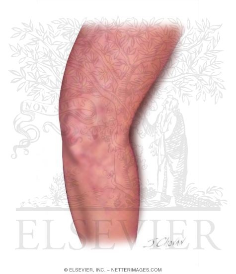 Livedo Reticularis