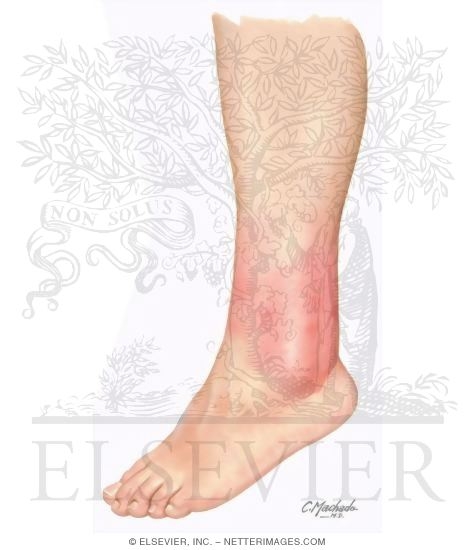 Typical Appearance of Erysipelas-like FMF Rash Often On Lower Extremities