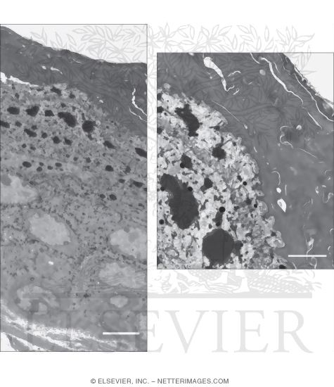 Electron Micrograph of a Vertical Section of the Epidermis Showing Its Layers at Low Magnification And Higher Magnification Electron Micrograph of the Upper Part of the
epidermis, Including the Stratum Granulosum and Stratum Corneum
