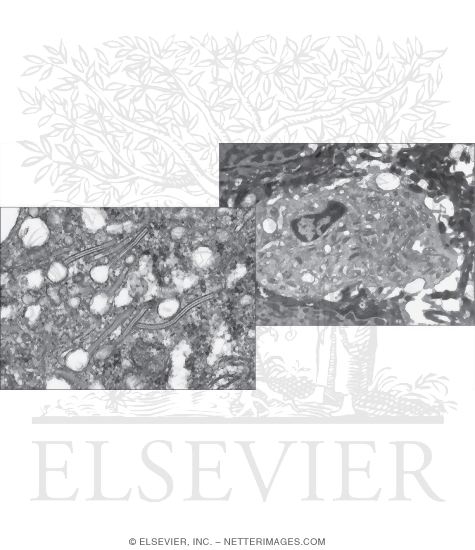 Watermarked preview of unlabeled image: Higher Magnification Electron Micrograph of a Langerhans Cell With Low-magnification Electron Micrograph of an Epidermal Langerhans Cell