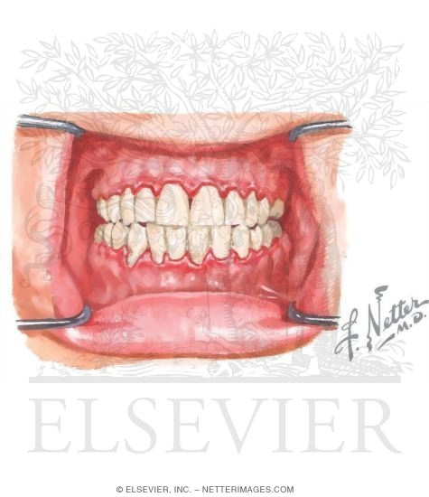 Marginal Gingivitis