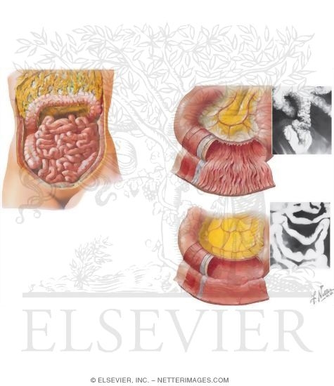 Topography and Relations of Transverse Colon and Greater Omentum Elevated Exposing Small Intestine With Structure of Jejunum and Ileum
