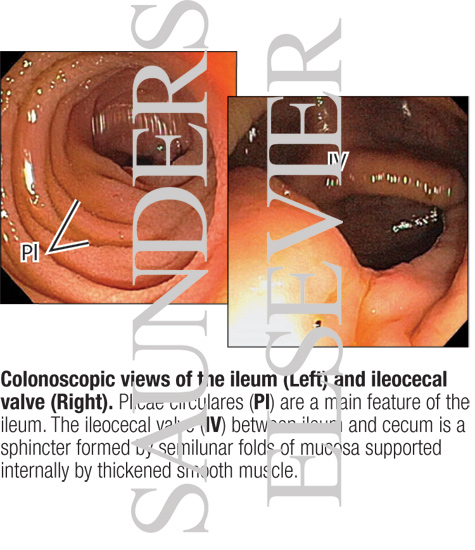 Colonoscopic Views of the Ileum (Left) and Ileocecal Valve (Right)