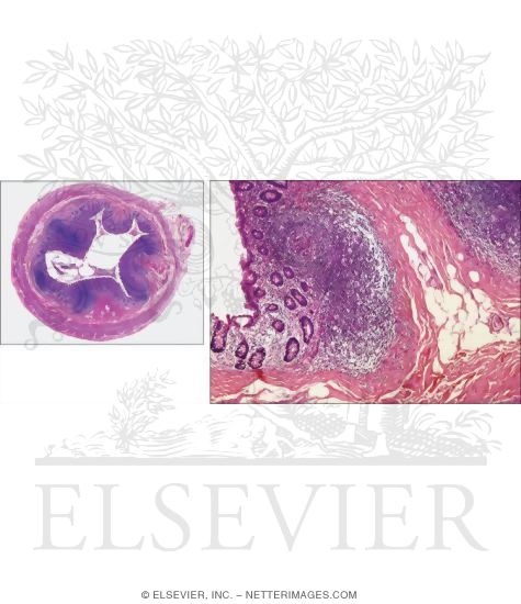 Light Micrograph of the Appendix In Transverse Section With Light Micrograph of Part of the Appendix
