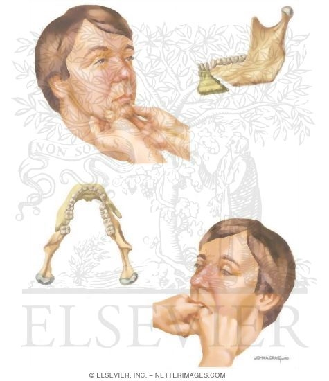 Watermarked preview of unlabeled image: Facial Trauma: Broken Jaw and Jaw Exam