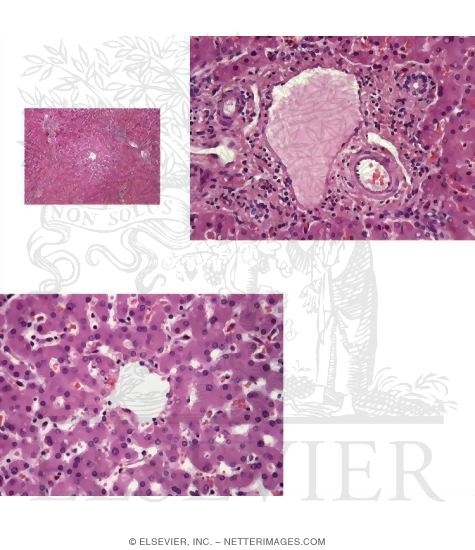 Watermarked preview of unlabeled image: Low-magnification Light Micrograph of a Hepatic Lobule With Light Micrograph of a Portal Tract and Light Micrograph of a Central Vein In the Center of a Hepatic Lobule