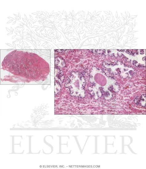 Watermarked preview of unlabeled image: Light Micrograph of Part of the Prostate With Light Micrograph of the Prostate at Low Magnification