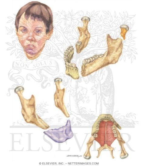 Facial Trauma: Broken Jaw and Child With Injured Chin