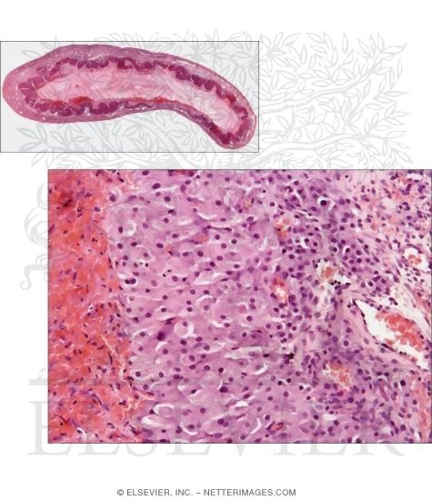 Low-power Light Micrograph of the Ovary With Light Micrograph of Part of the Corpus Luteum