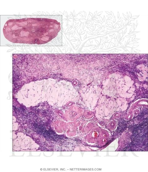 Watermarked preview of unlabeled image: Low-magnification Light Micrograph of a Postmenopausal Ovary With Higher Magnification Light Micrograph of Part of a Postmenopausal Ovary
