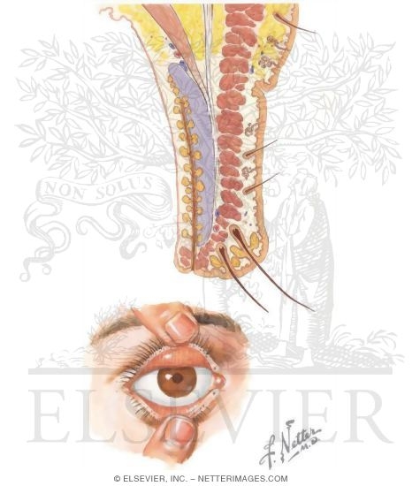 Watermarked preview of unlabeled image: Section of Eyelid, and Eyelid Retracted (Anterior View)