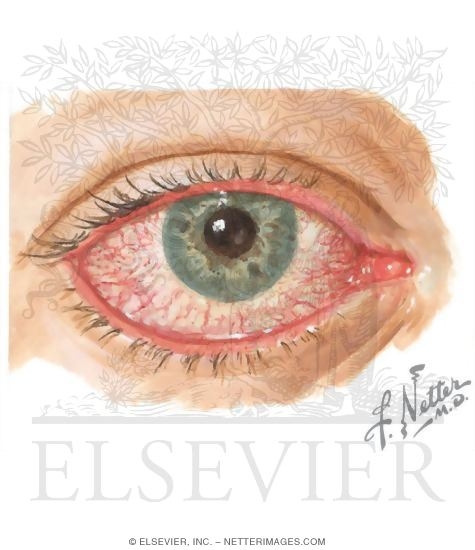 Conjunctivitis