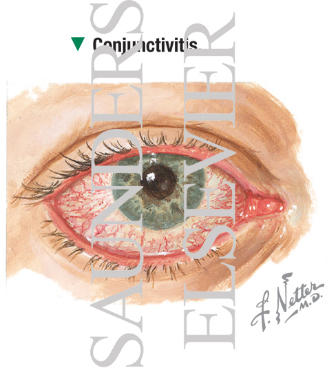 Watermarked preview of labeled image: Conjunctivitis