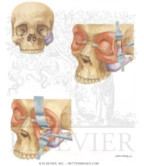 Facial Trauma: Repair of Broken Cheekbone