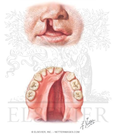 Watermarked preview of unlabeled image: Cleft Lip and Palate