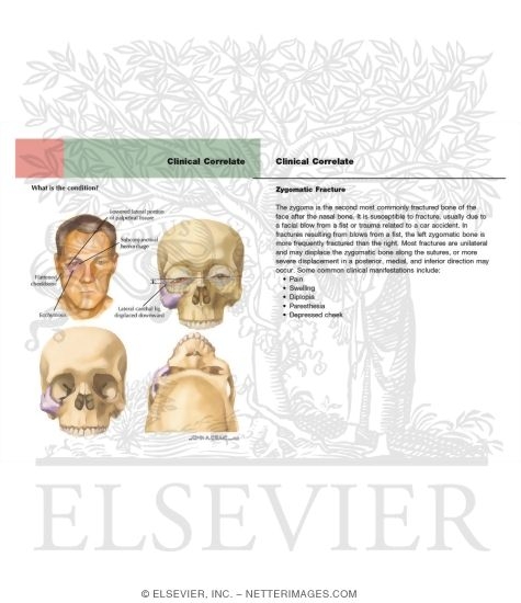 Watermarked preview of labeled image: Zygomatic Fractures