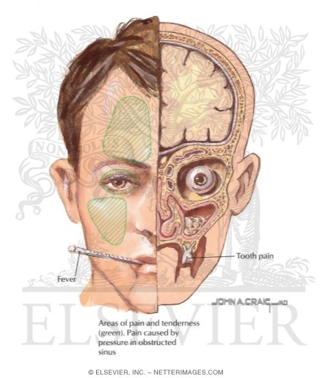 Sinusitis