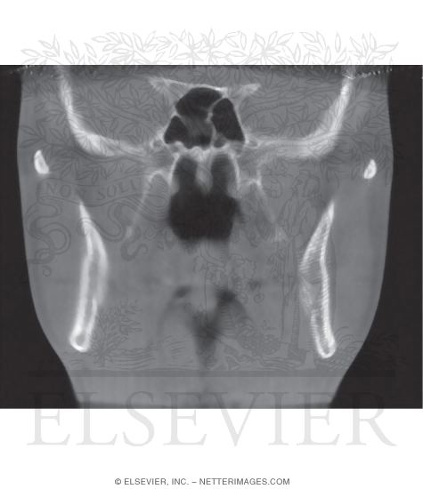 CT Image: Coronal View