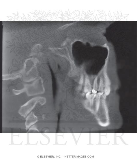 CT Image: Sagittal View